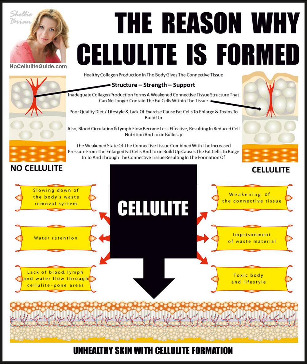How is Cellulite Formed?